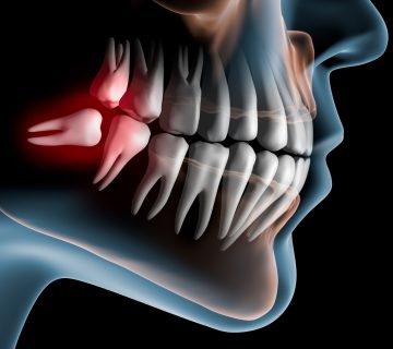 بهترین زمان کشیدن دندان عقل