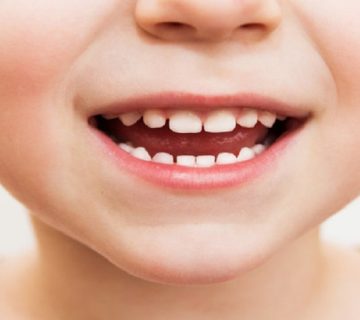 مراحل رویش و تکامل دندان‌های شیری